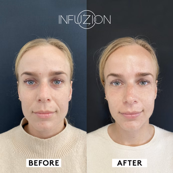 Infuzion Boozter Vorher Nachher