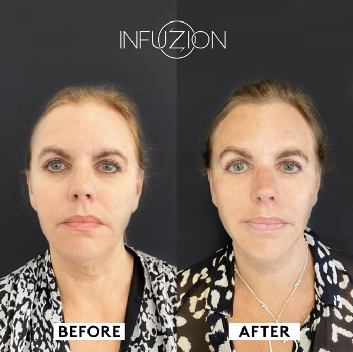 Infuzion Boozter Vorher Nachher