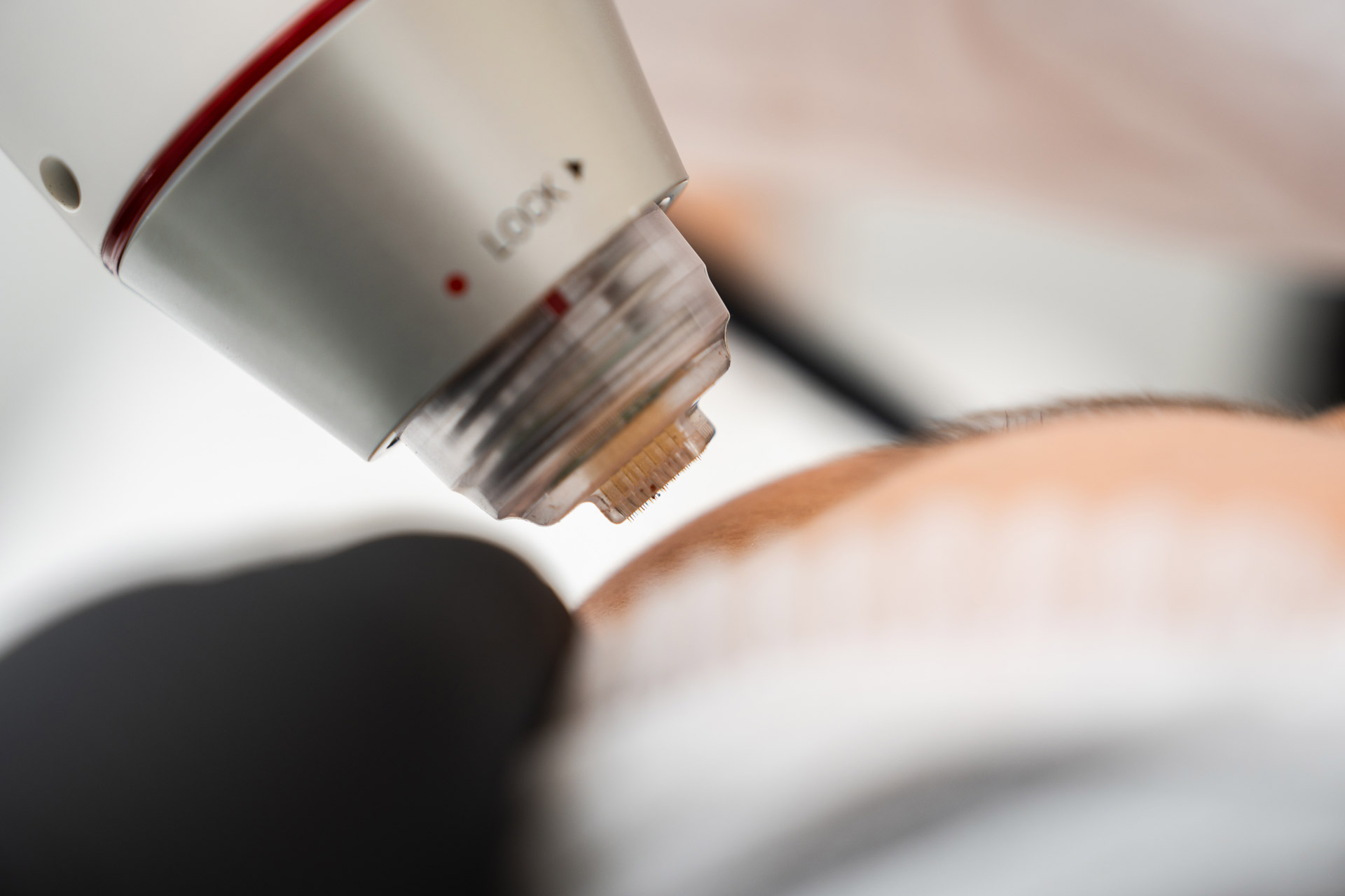 Laserbehandlung in Basel